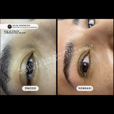 Kaş Kirpik Laminasyon Öncesi Sonrası Mersin