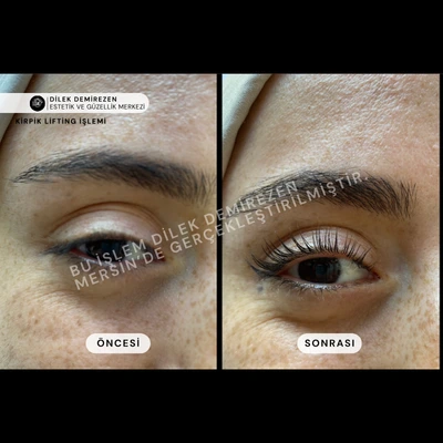 Kirpik Lifting Öncesi Sonrası Mersin