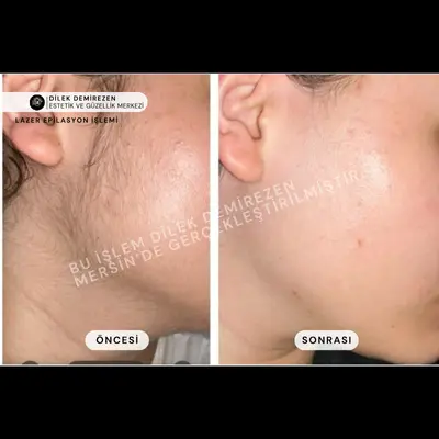 Lazer Epilasyon Öncesi Sonrası Mersin