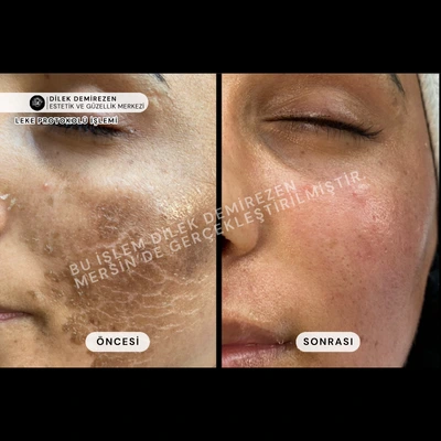 Leke Tedavisi Öncesi Sonrası Mersin