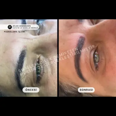 Kaş Pudralama Öncesi Sonrası Mersin